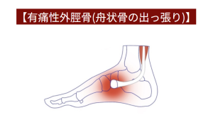 有痛性外脛骨